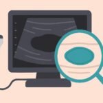 Ecografia mammaria: fibroadenoma ovale a margini regolari evidenziato da lente di ingrandimento, nodulo benigno del seno.