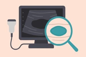 Ecografia mammaria: fibroadenoma ovale a margini regolari evidenziato da lente di ingrandimento, nodulo benigno del seno.