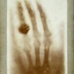 Prima radiografia medica della storia: la mano di Anna Bertha Ludwig fotografata da Wilhelm Röntgen nel 1895, immagine simbolo della scoperta dei raggi X e dell’inizio della radiologia moderna