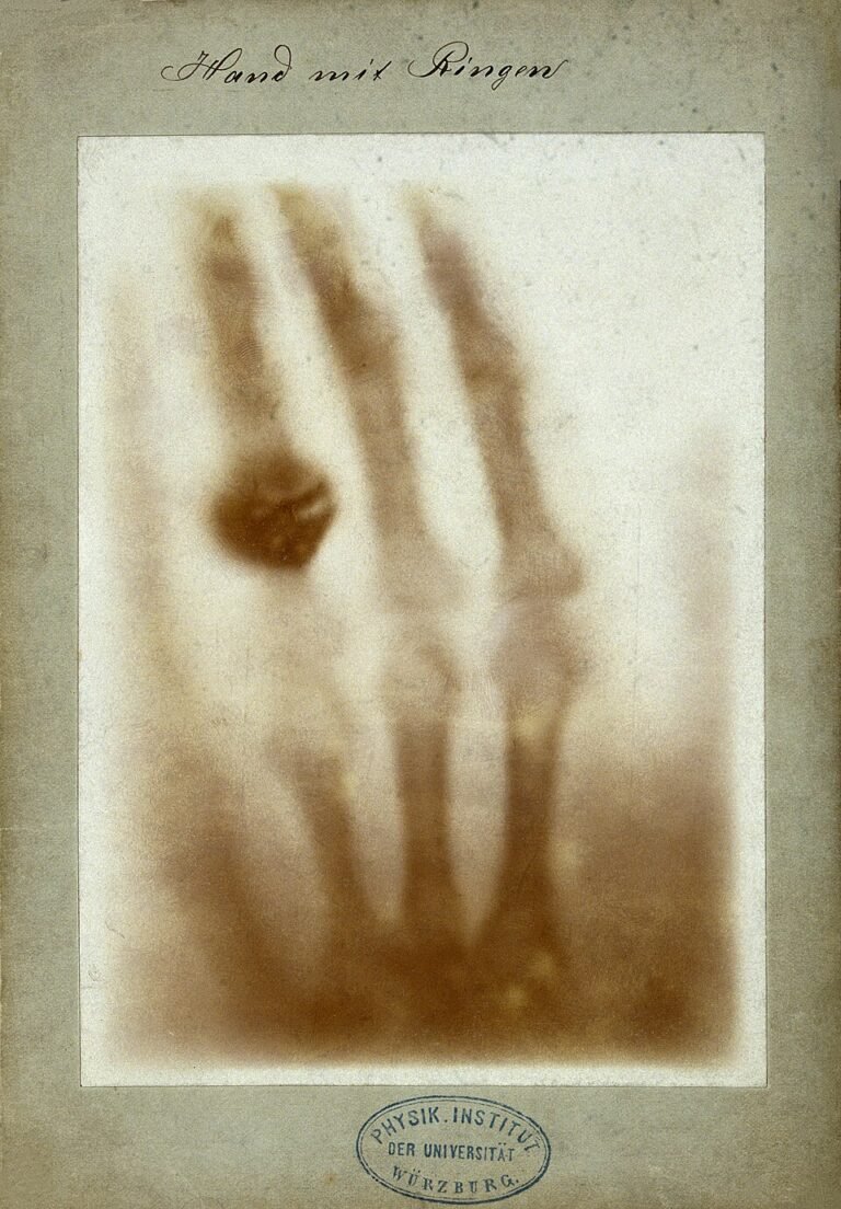 Prima radiografia medica della storia: la mano di Anna Bertha Ludwig fotografata da Wilhelm Röntgen nel 1895, immagine simbolo della scoperta dei raggi X e dell’inizio della radiologia moderna