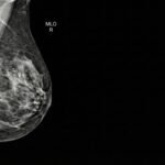 Mammografia in proiezione medio-laterale obliqua (MLO) destra che evidenzia un cluster di microcalcificazioni pleomorfe sospette per Carcinoma Duttale In Situ (DCIS)
