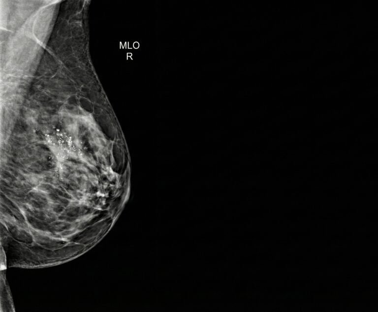 Mammografia in proiezione medio-laterale obliqua (MLO) destra che evidenzia un cluster di microcalcificazioni pleomorfe sospette per Carcinoma Duttale In Situ (DCIS)