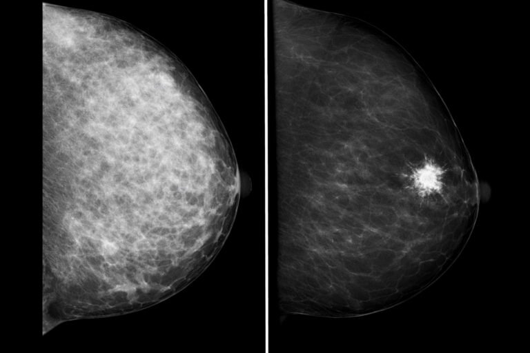 CESM Mammografia con mezzo di contrasto - Confronto RMLO: mammografia con densità mammaria ACR D vs CESM con mezzo di contrasto che evidenzia un nodulo spiculato in enhancement, non visibile alla mammografia standard.