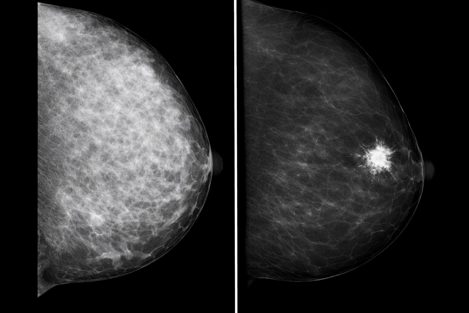 CESM Mammografia con mezzo di contrasto - Confronto RMLO: mammografia con densità mammaria ACR D vs CESM con mezzo di contrasto che evidenzia un nodulo spiculato in enhancement, non visibile alla mammografia standard.