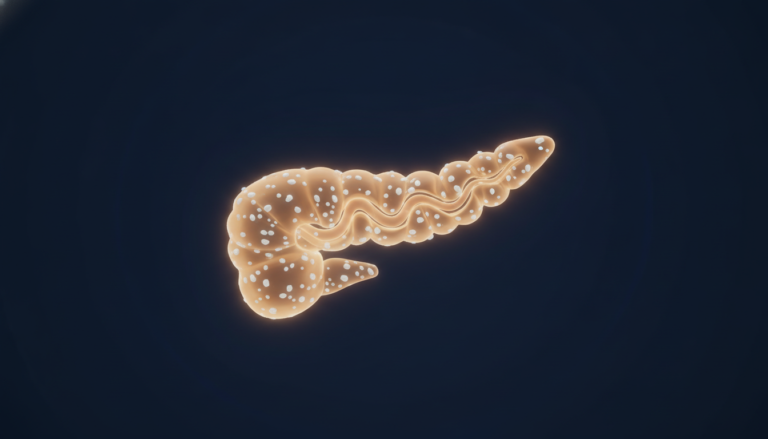 Illustrazione 3D stilizzata del pancreas con calcificazioni parenchimali e dotto di Wirsung dilatato, segni caratteristici di pancreatite cronica all'imaging
